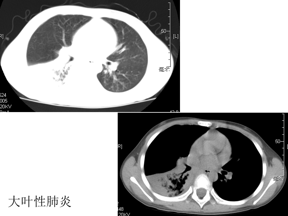 医院呼吸系统及纵膈CT图片.ppt_第3页