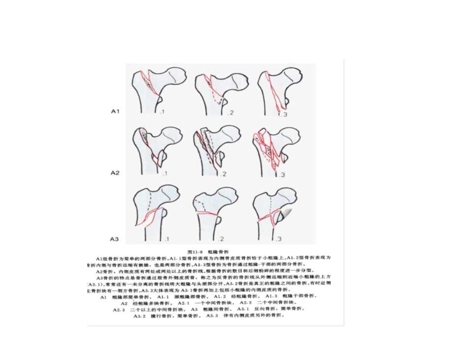 骨质疏松性股骨粗隆间骨折.ppt_第2页