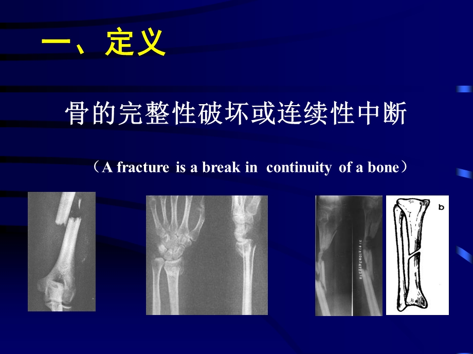 骨折概论（精品ＰＰＴ） .ppt_第3页