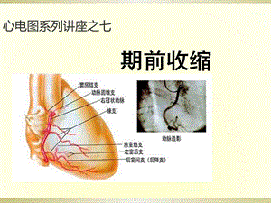 心电图系列讲座7期前收缩.ppt