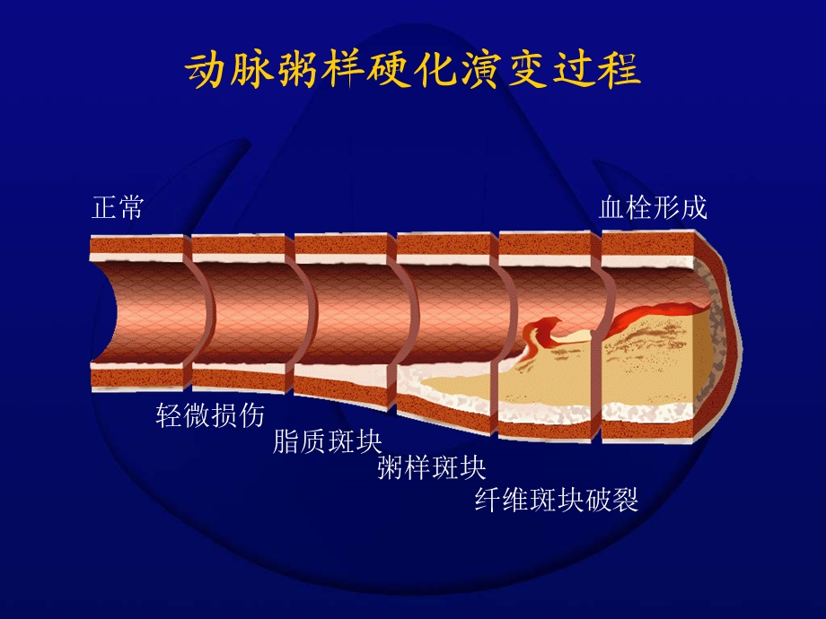 外周动脉闭塞症的抗凝及抗血小板治疗_时德.ppt_第3页