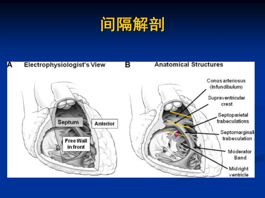 右心室间隔部起搏-tool and skill.ppt_第3页