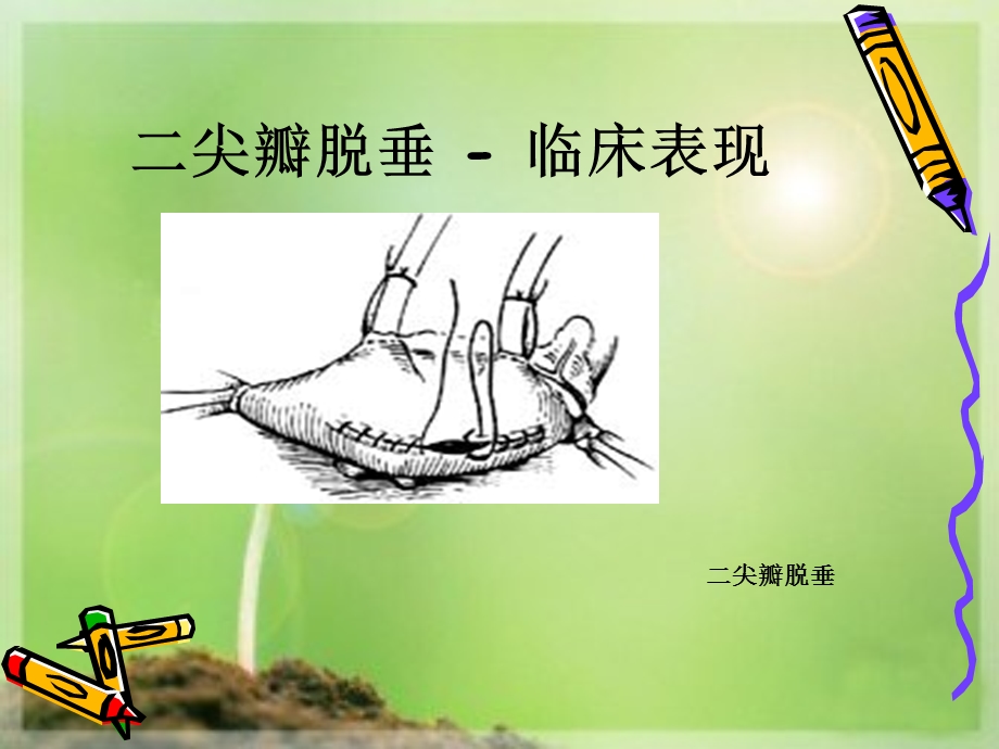 二尖瓣脱垂.ppt_第3页