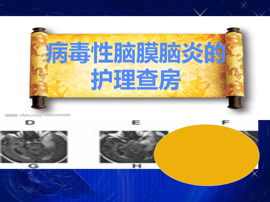 病毒性脑炎护理查房(1).ppt_第1页