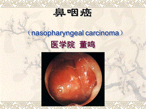 常见重要疾病防治-鼻咽癌(1).ppt