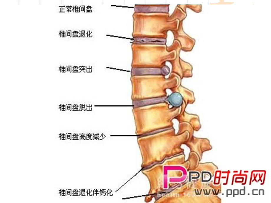 腰椎间盘突出症治疗方案.ppt_第3页