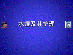 水痘及其护理.ppt