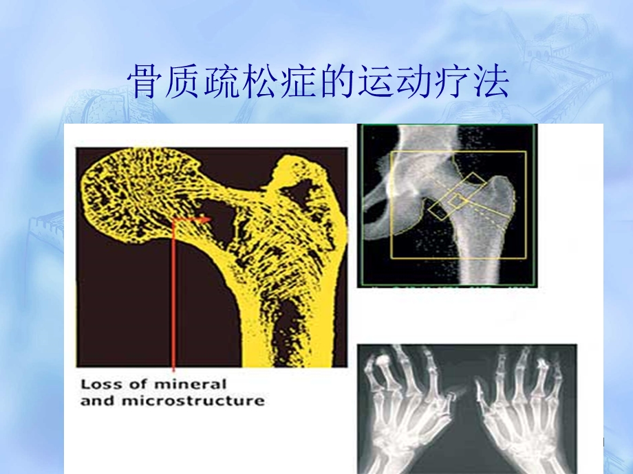 骨质疏松症的运动疗法.ppt_第1页