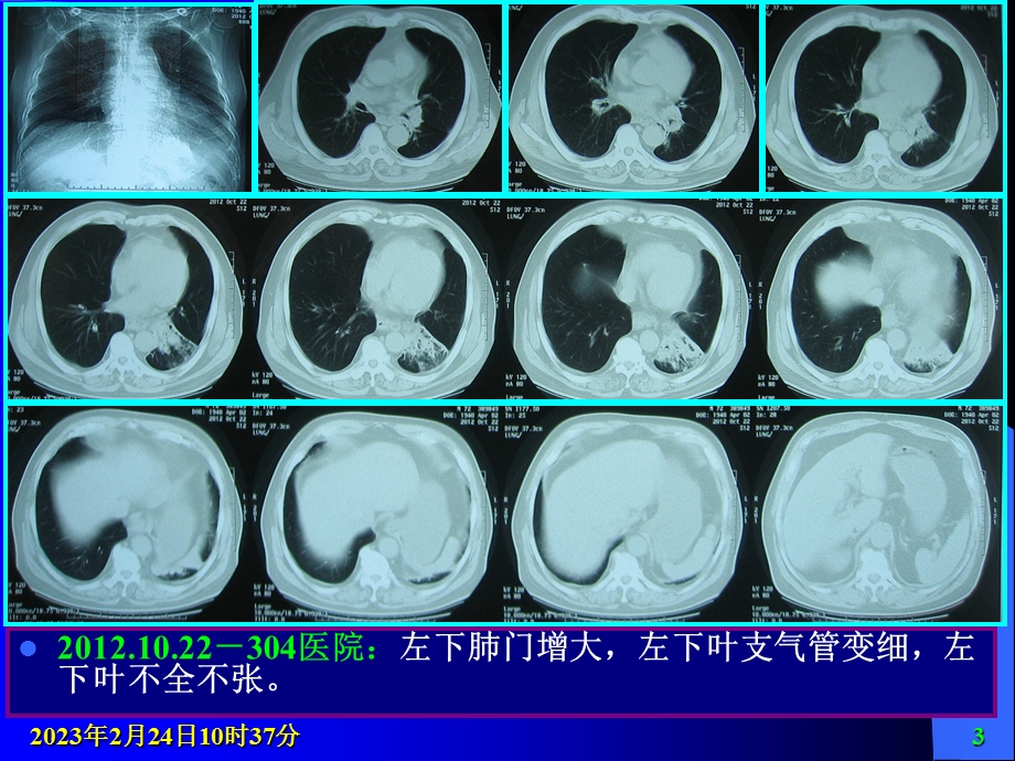 肺隔离症.ppt_第3页