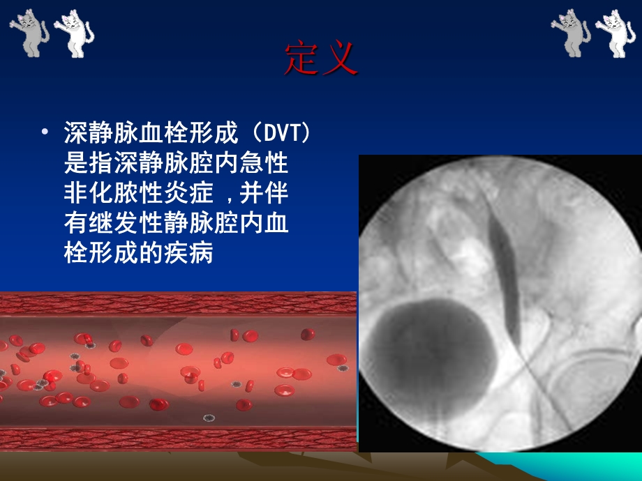 深静脉血栓的治疗和护理.ppt_第2页