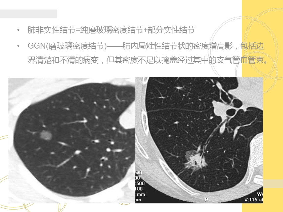 影像学专用--修改稿讲课专用Fleischner肺非实性结节处理ppt.ppt_第2页