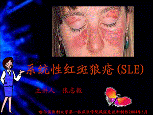 系统性红斑狼疮(SLE).ppt.ppt