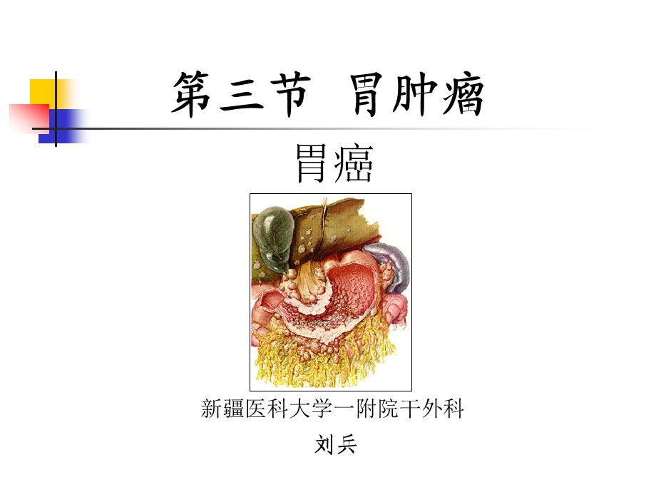 胃癌.ppt.ppt_第1页