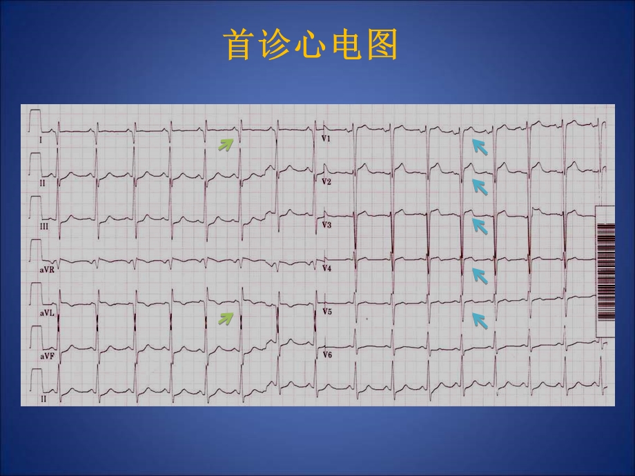 不明原因青年心肌梗死.ppt_第2页