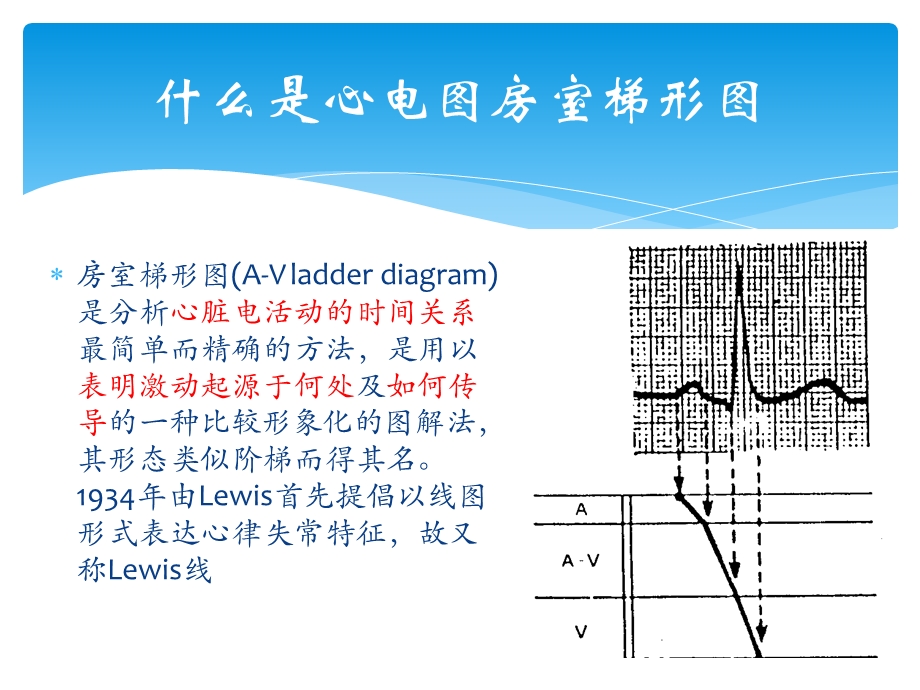 梯形图在分析复杂心律失常中的作用.ppt_第3页