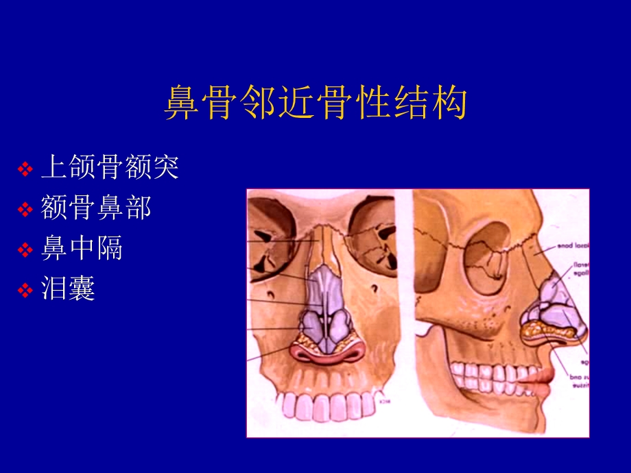 鼻骨骨折影像学诊断.ppt_第3页