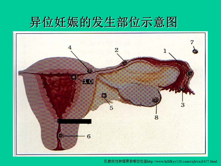 异位妊娠的病因和诊断方法.ppt_第3页