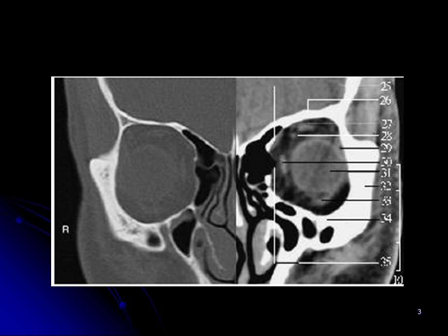 常见眼眶内原发性肿瘤的诊断（二） .ppt_第3页