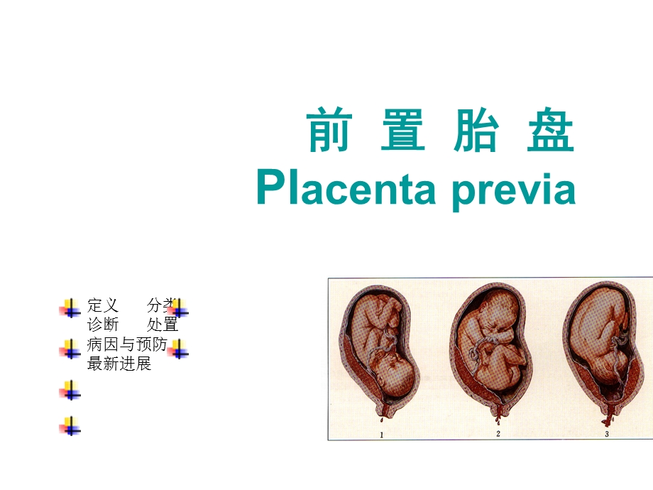 前置胎盘[精彩].ppt_第3页