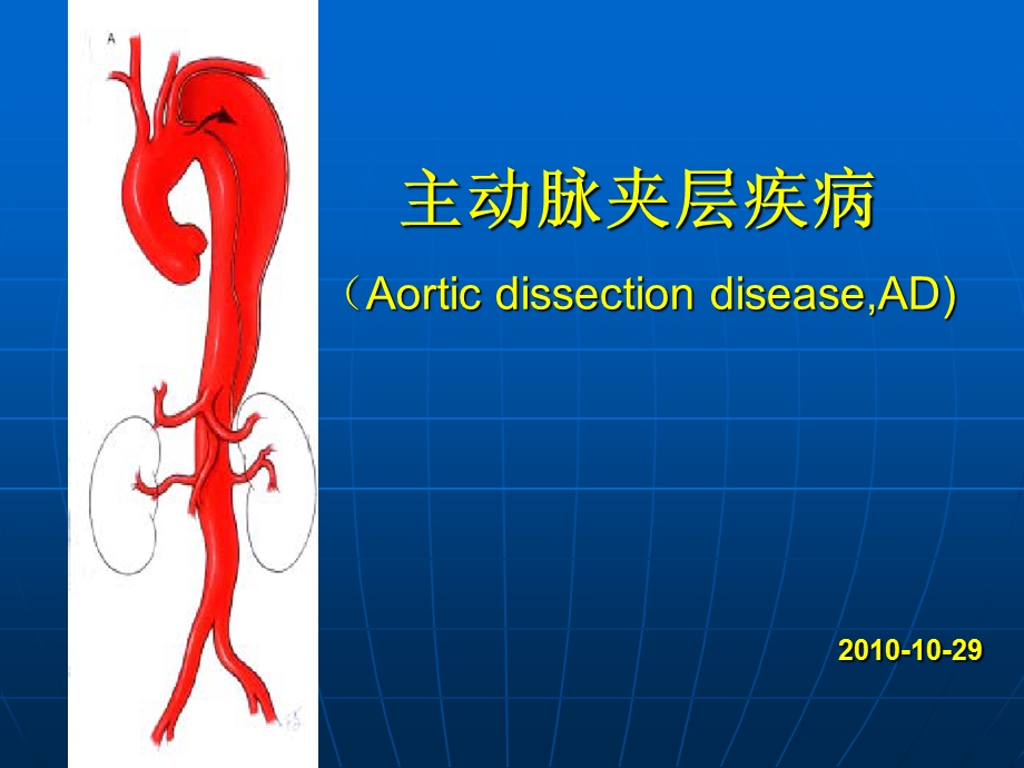 主动脉夹层(1).ppt_第1页