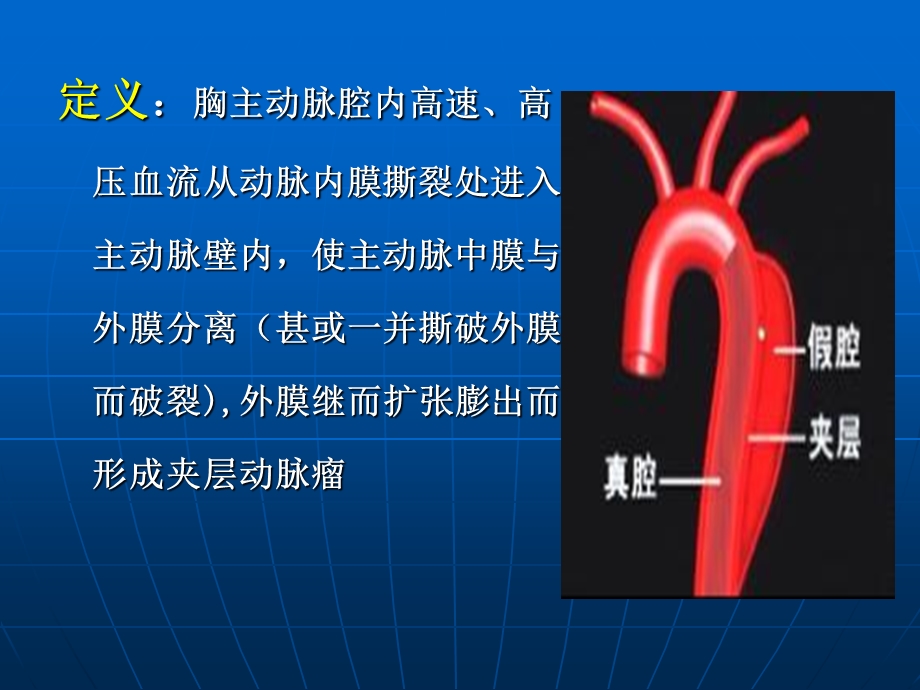 主动脉夹层(1).ppt_第3页