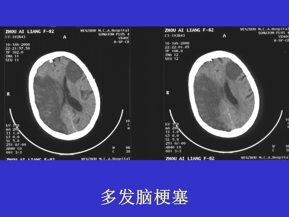 常见疾病的典型CT片.ppt_第2页