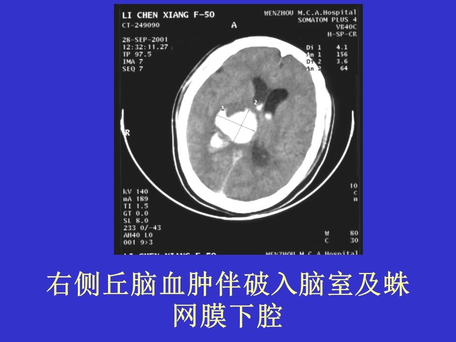 常见疾病的典型CT片.ppt_第3页