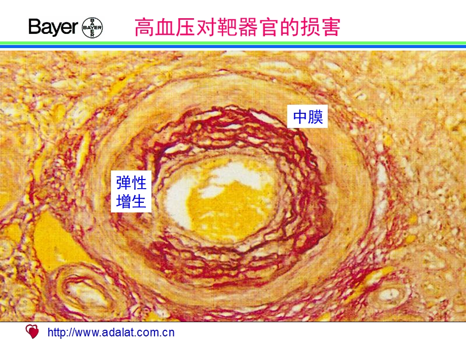 高血压对靶器官的损害(1).ppt_第3页