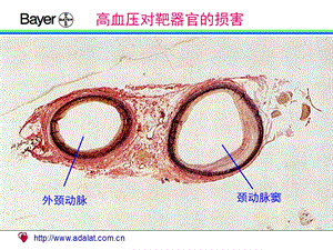 高血压对靶器官的损害(1).ppt