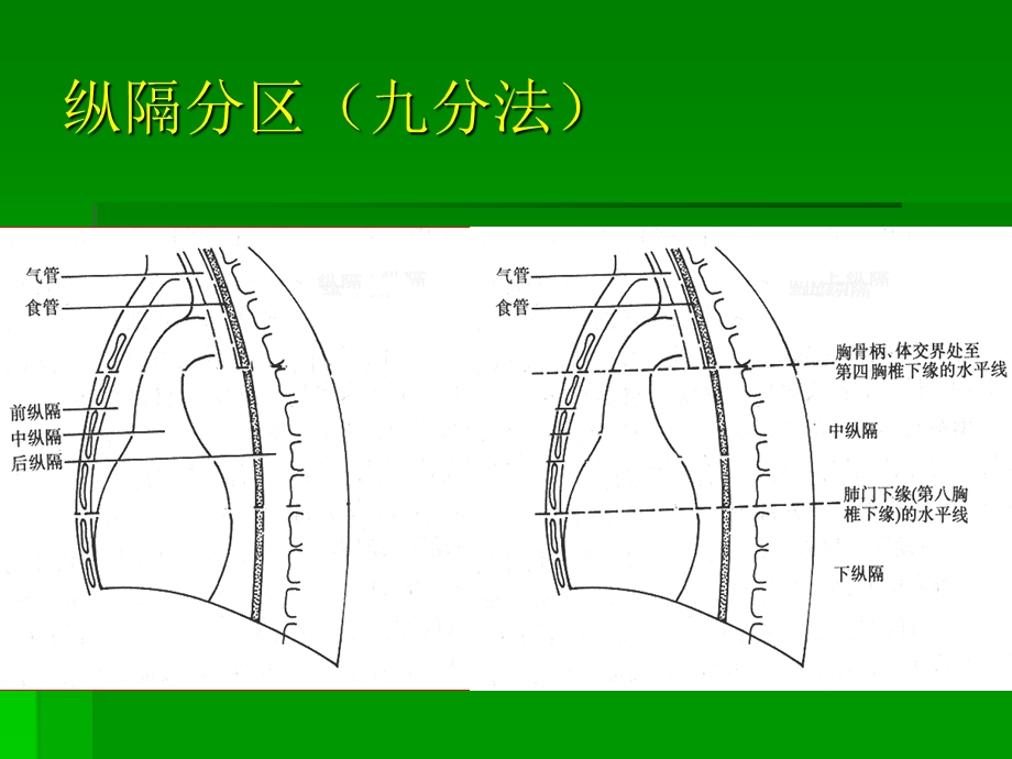 纵隔疾病.ppt_第3页