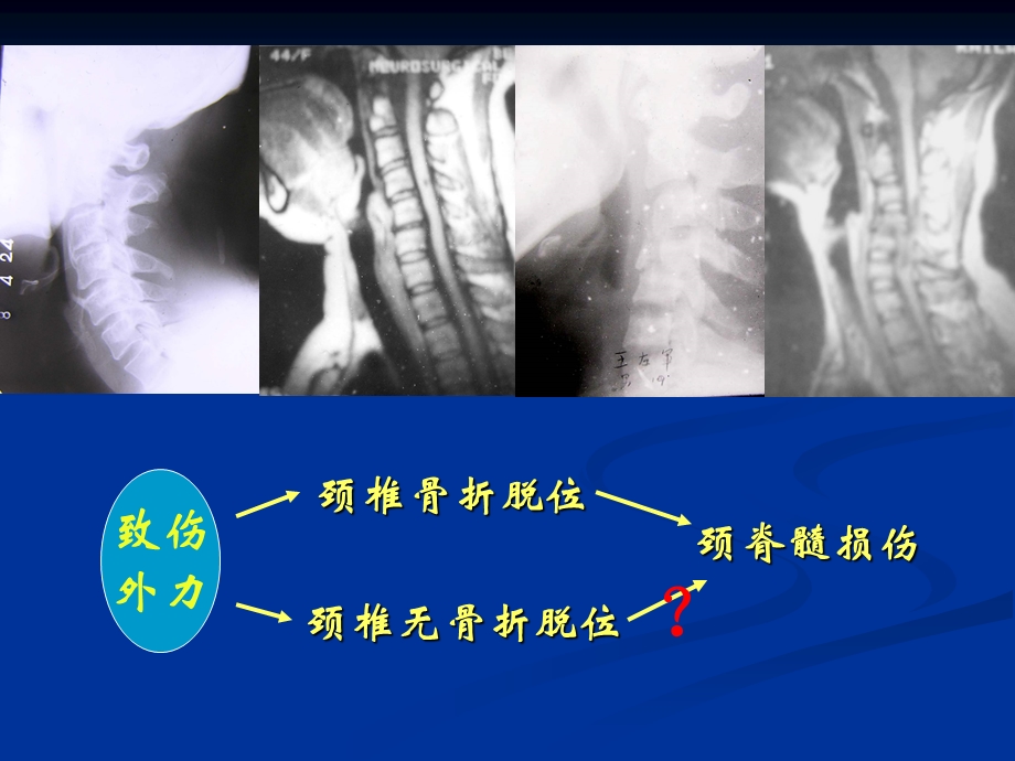 无骨折脱位型急性颈脊髓损伤－danggenting.ppt_第2页