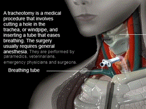 气管切开术(Tracheotomy).ppt