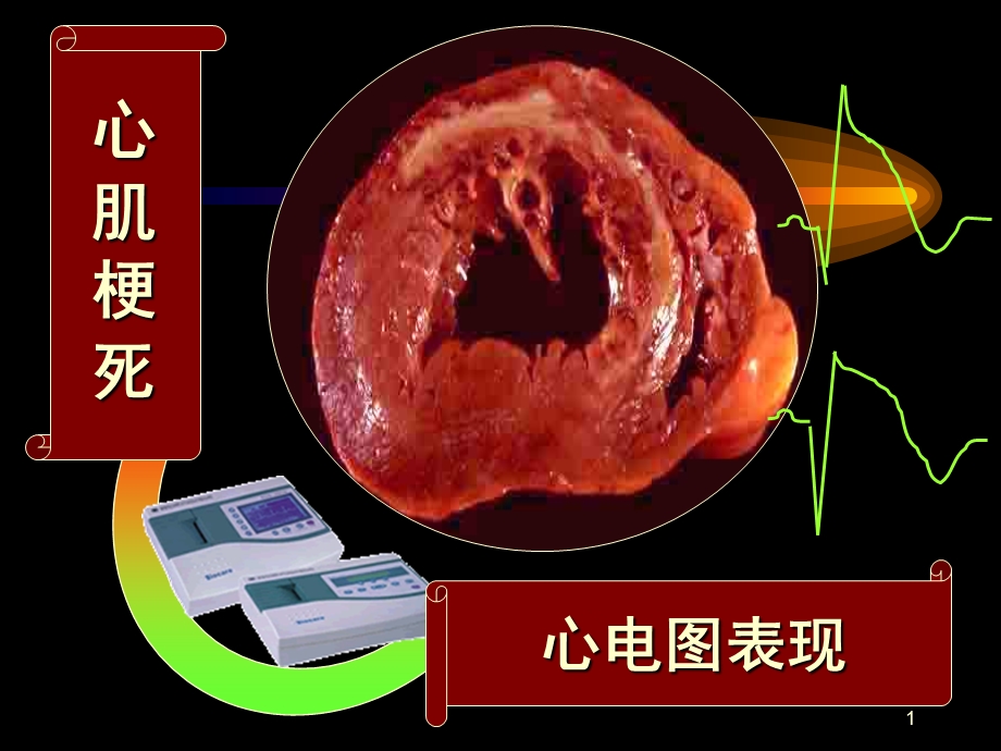 心肌梗死-6.ppt_第1页