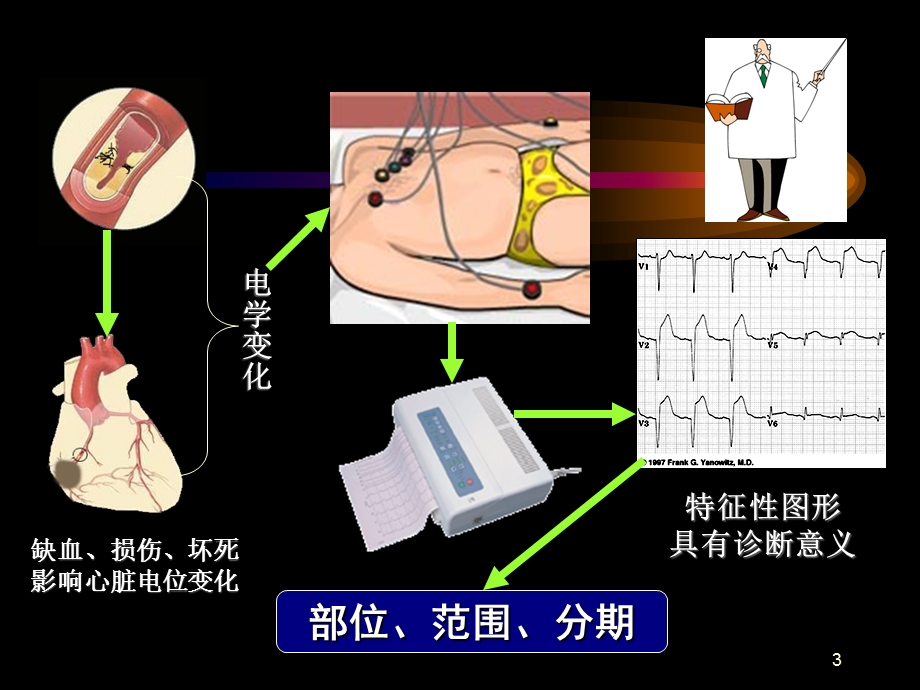 心肌梗死-6.ppt_第3页