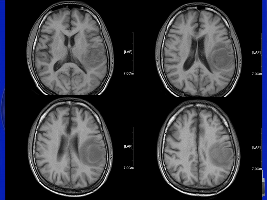影像科经典读片之三脑淋巴瘤.ppt_第3页