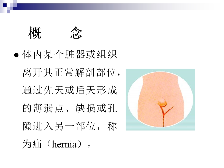 第40章腹外疝.ppt_第3页