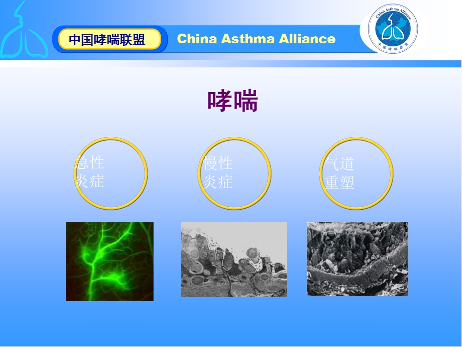 [精品]慢性哮喘的药物联合治疗.ppt_第3页