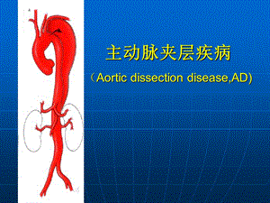 主动脉夹层.ppt.ppt