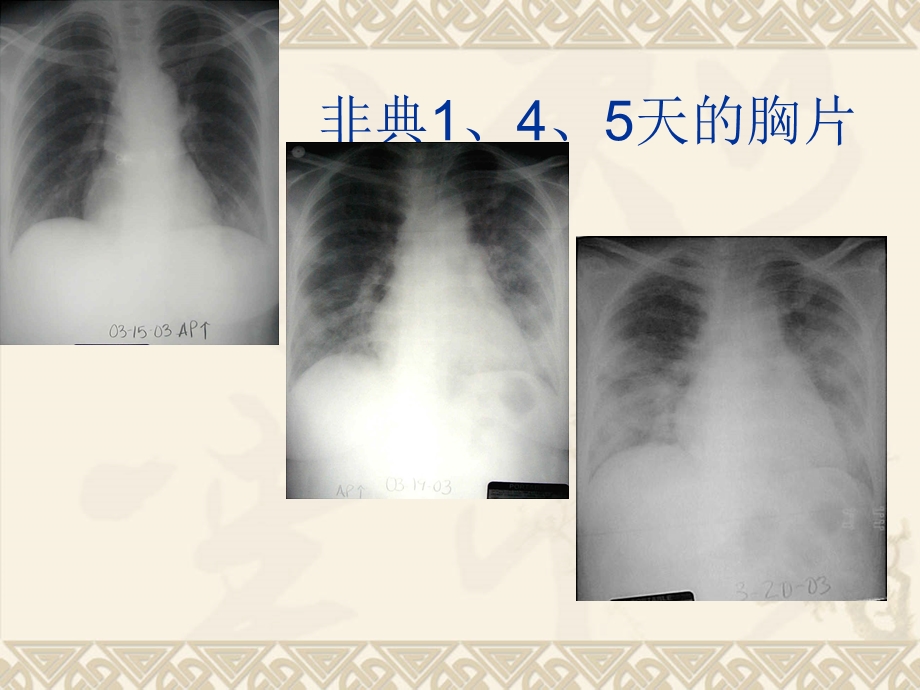 呼吸机的急诊应用.ppt_第2页