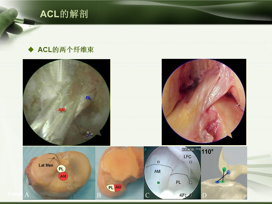 ACL损伤影像学诊断.ppt_第2页