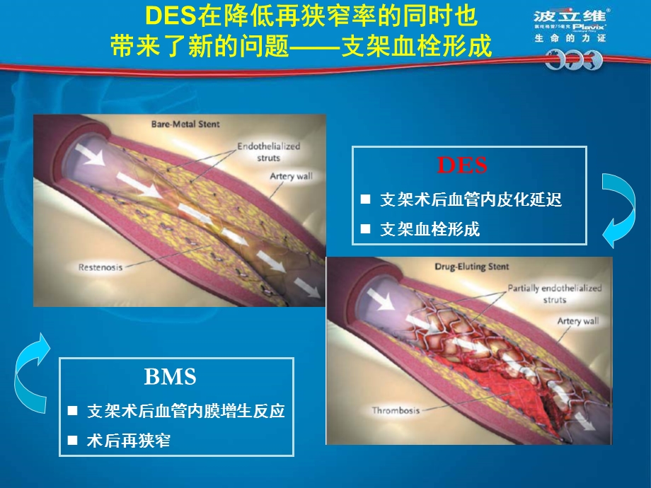 抗血小板治疗中的实际问题及解决策略霍勇.ppt_第3页