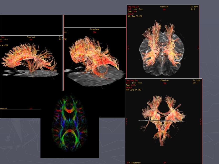 DTI的基本原理及其在中枢神经系统中的应用.ppt_第3页
