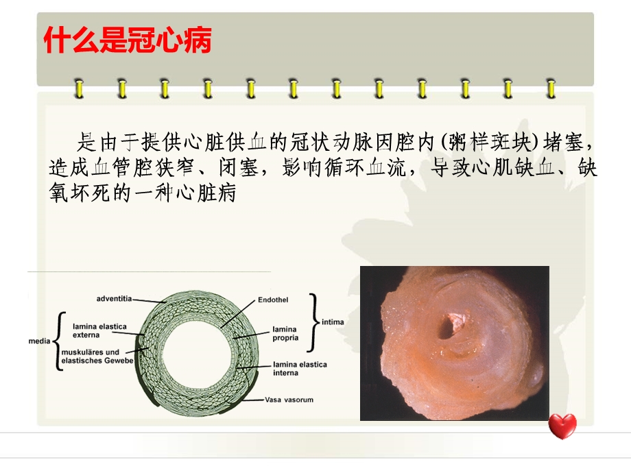 冠心病的介入治疗3.ppt_第2页