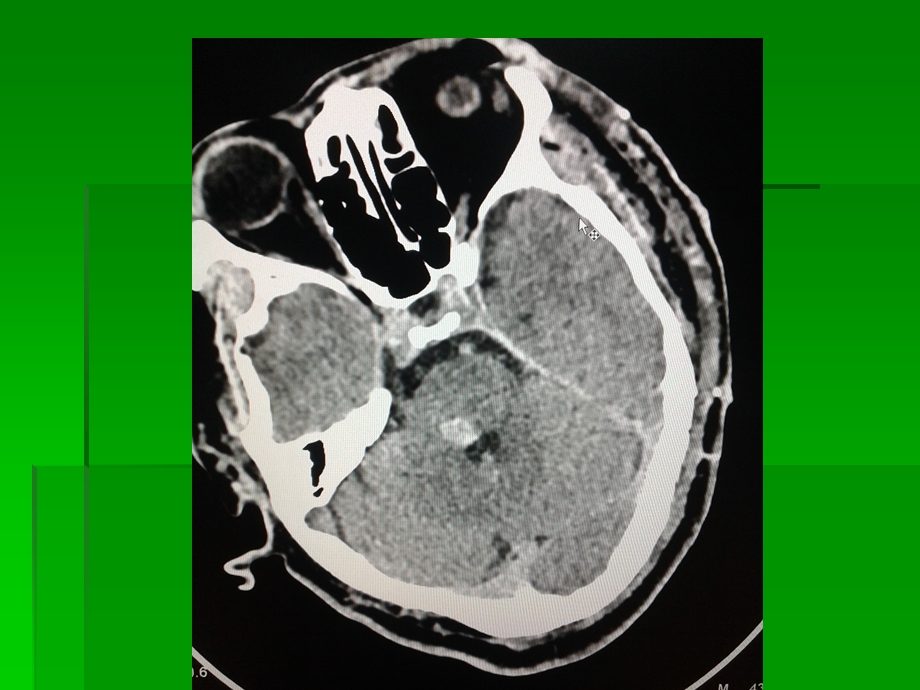 脑干海绵状血管瘤MRI.ppt_第3页