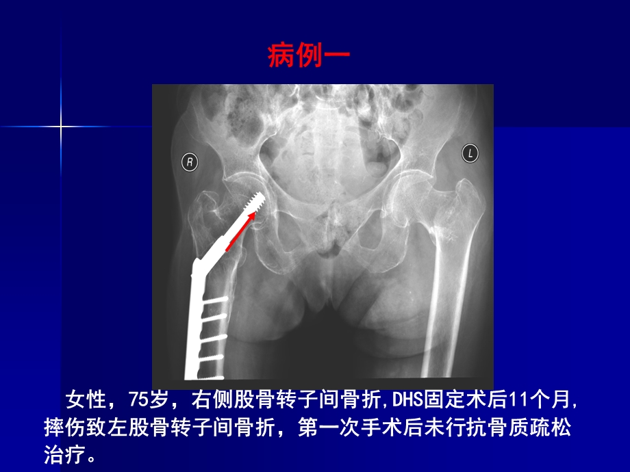 骨质疏松症诊断与防治.ppt.ppt_第3页