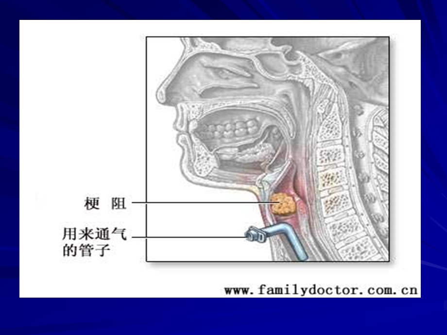 急性喉梗阻.ppt.ppt_第3页