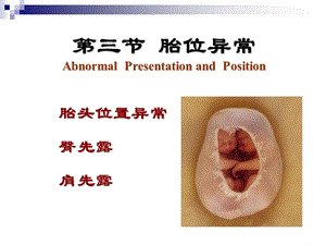 胎位异常教案PPT(1).ppt