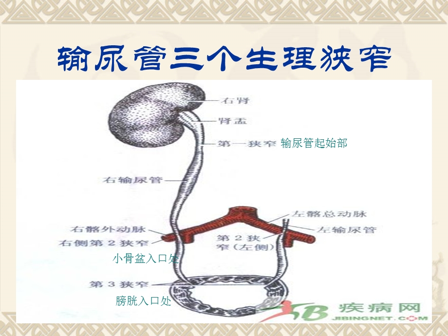 输尿管结石病人护理.ppt_第2页