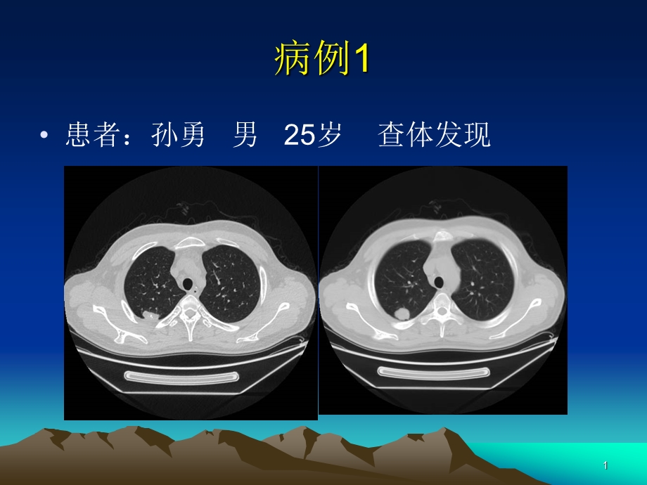 医学ppt肺错构瘤影像表现.ppt_第1页