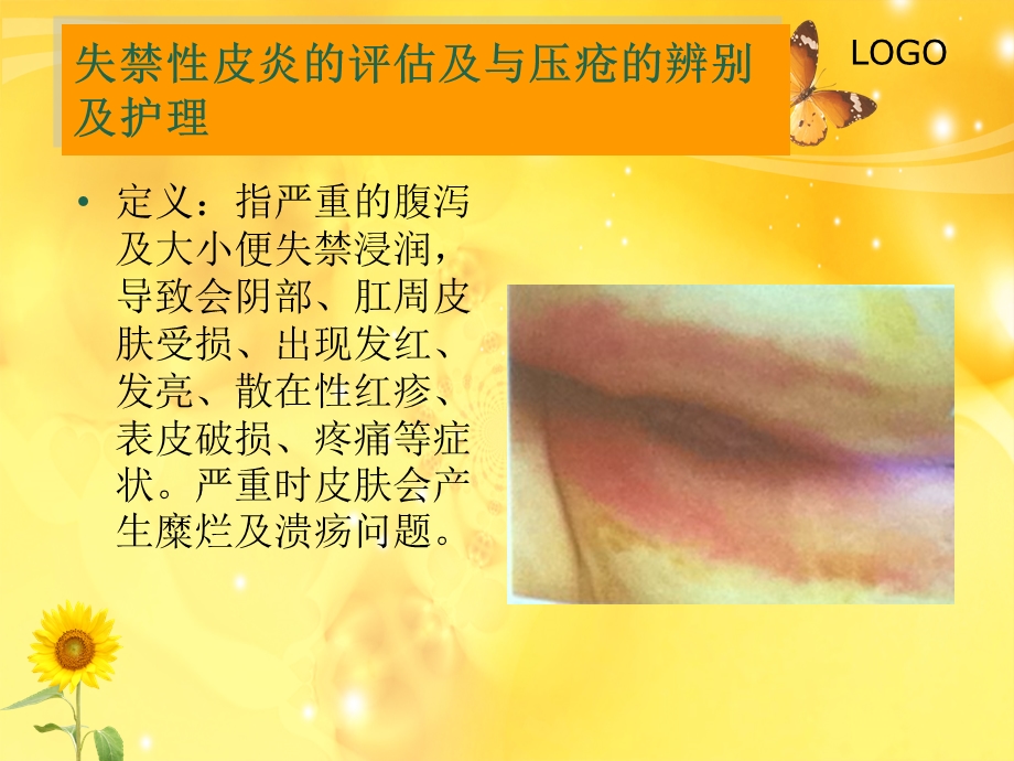 压疮的分级和护理.ppt_第3页